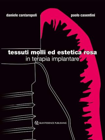 Tessuti molli ed estetica rosa in terapia implantare